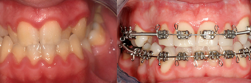 Caso clinico Ortodonzia, Chirurgia, Corone e Faccette 1
