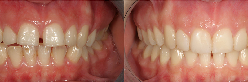 Caso clinico Ortodonzia, Ricostruzioni in composito 1
