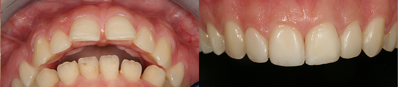 Caso clinico Ortodonzia, Ricostruzioni in composito 2
