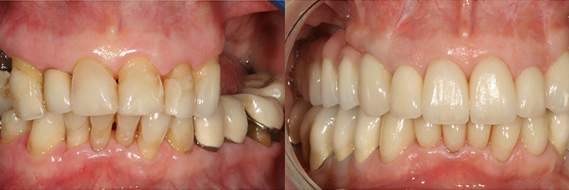 Caso clinico Rigenerazione ossea, Impianti, Corone e Faccette 1