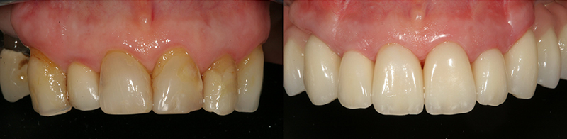 Caso clinico Rigenerazione ossea, Impianti, Corone e Faccette 2