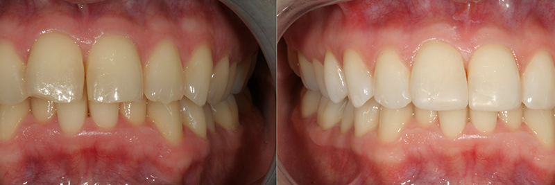 Caso clinico Sbiancamento e Ricostruzione in composito 1